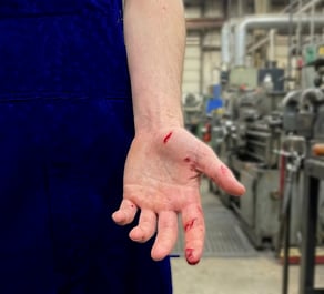 Injured hand in factory